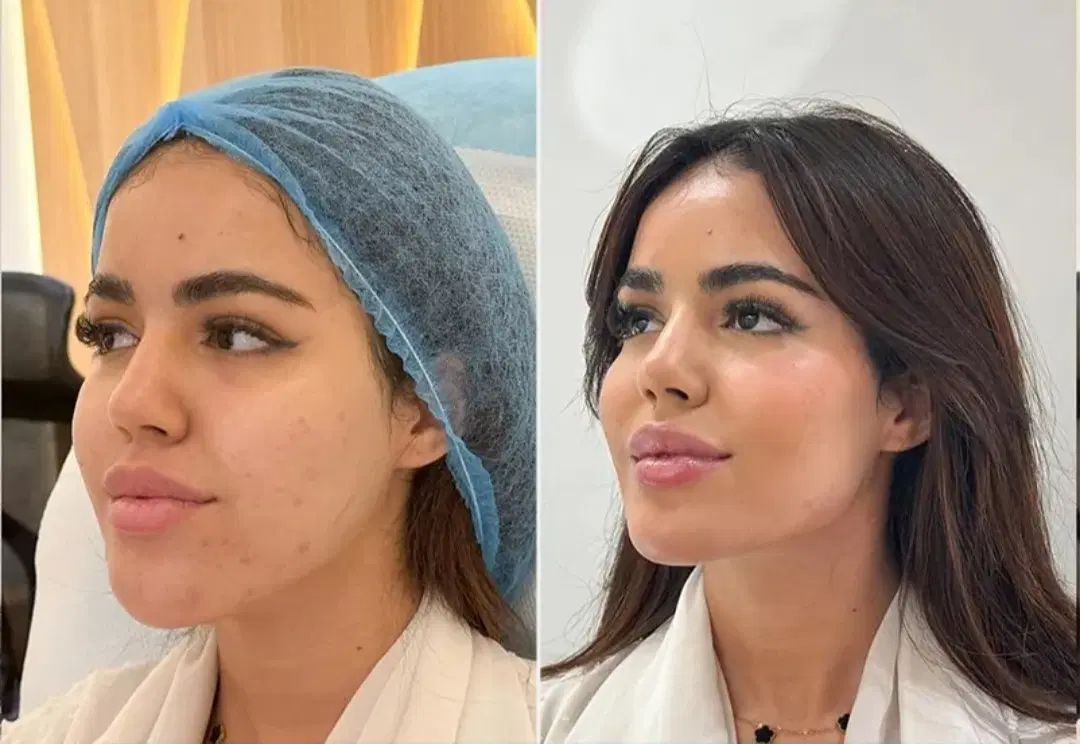 فول فیس ژل لب فیلربیکینی تخفیفات فقط دو روز|خدمات آرایشگری و زیبایی|مشهد, احمدآباد|دیوار