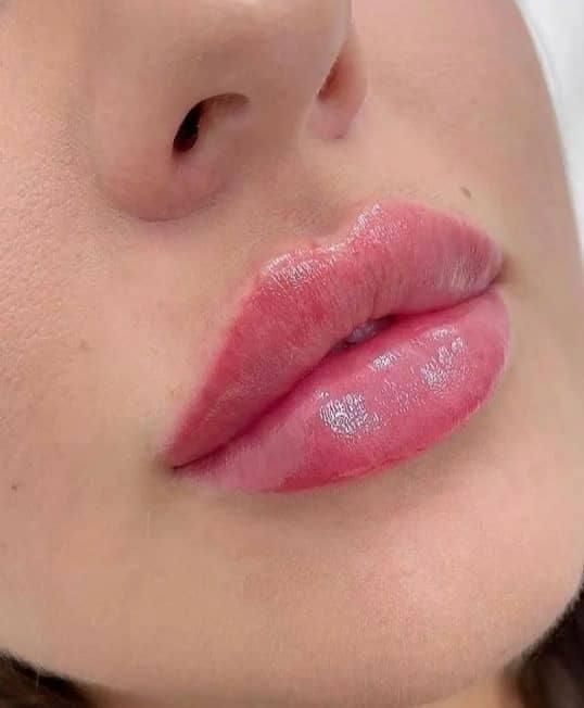 تزریق ژل بوتاکس لیزر هایفو مزو پی ار پی نخ فیشیال|خدمات آرایشگری و زیبایی|شهریار, |دیوار