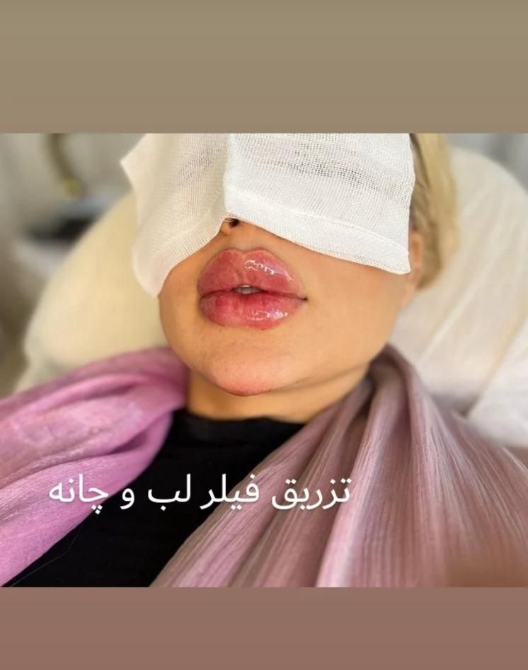 تزریق ژل و بوتاکس پک مادلینگ، مزونیدلینگ ۵۰٪تخفیف|خدمات آرایشگری و زیبایی|پردیس, فاز ۱|دیوار