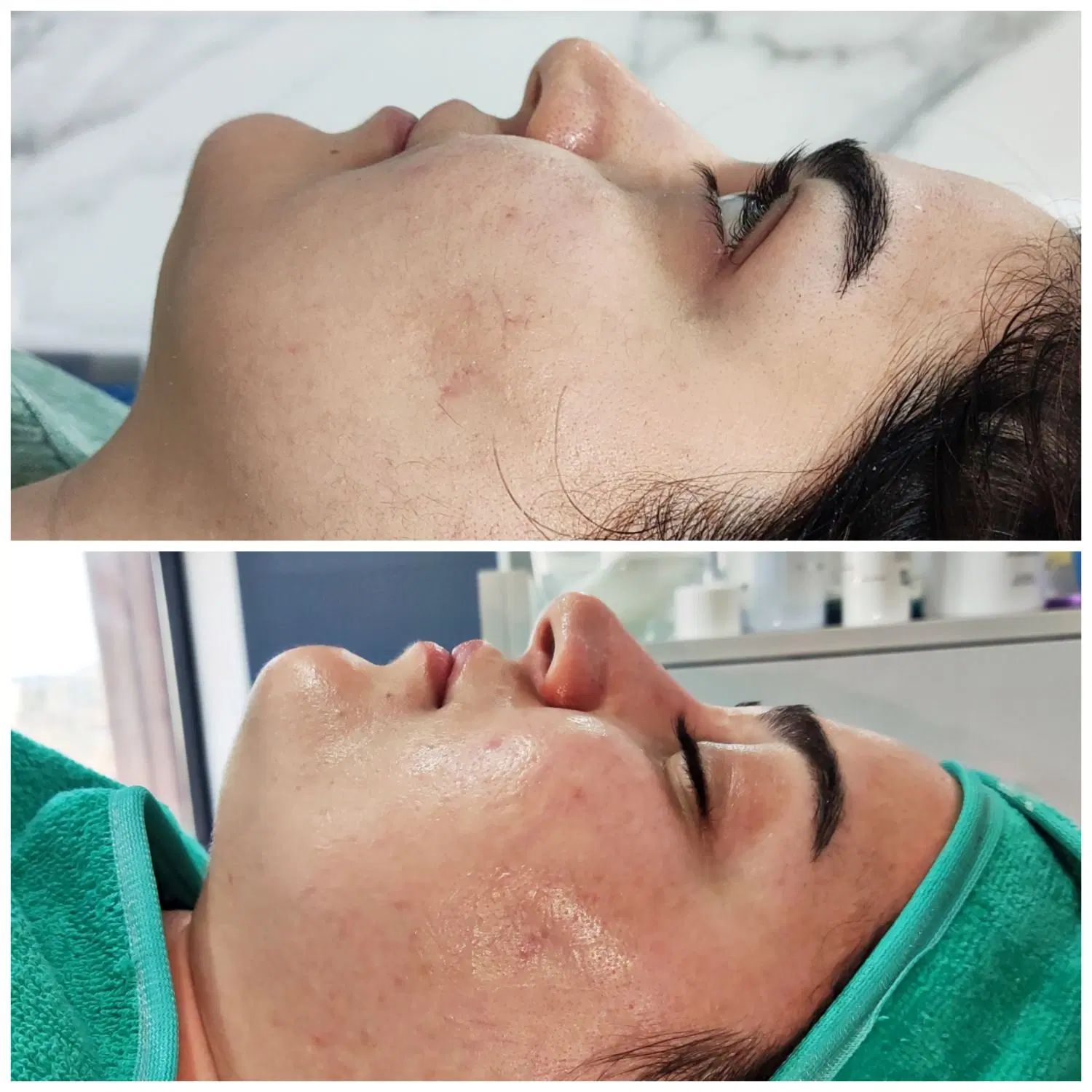 پاکسازی پوست،درمان منافذ باز،آکنه،تخلیه سر سیاه|خدمات آرایشگری و زیبایی|اهواز, سپیدار|دیوار