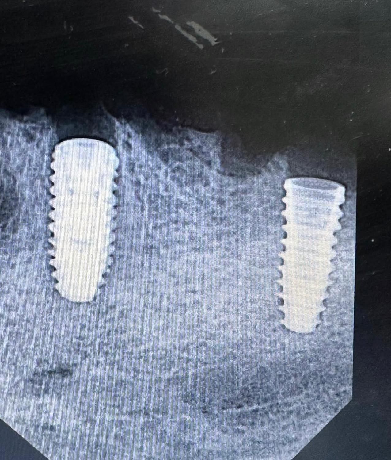 ایمپلنت با شرایط ویژه|خدمات آرایشگری و زیبایی|ارومیه, |دیوار