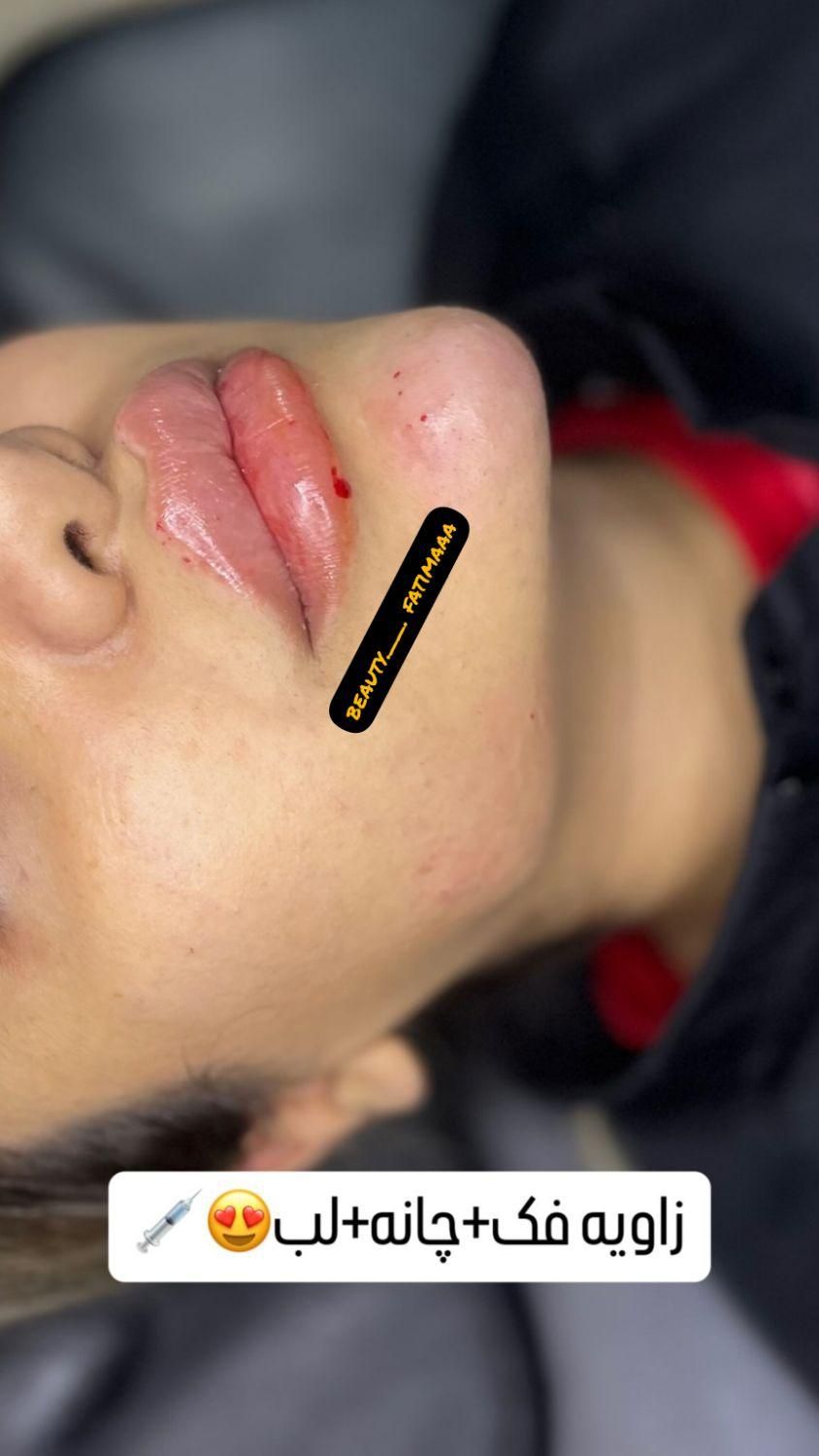 تزریق ژل لب و بوتاکس|خدمات آرایشگری و زیبایی|شیراز, شهرک مهدی‌آباد|دیوار