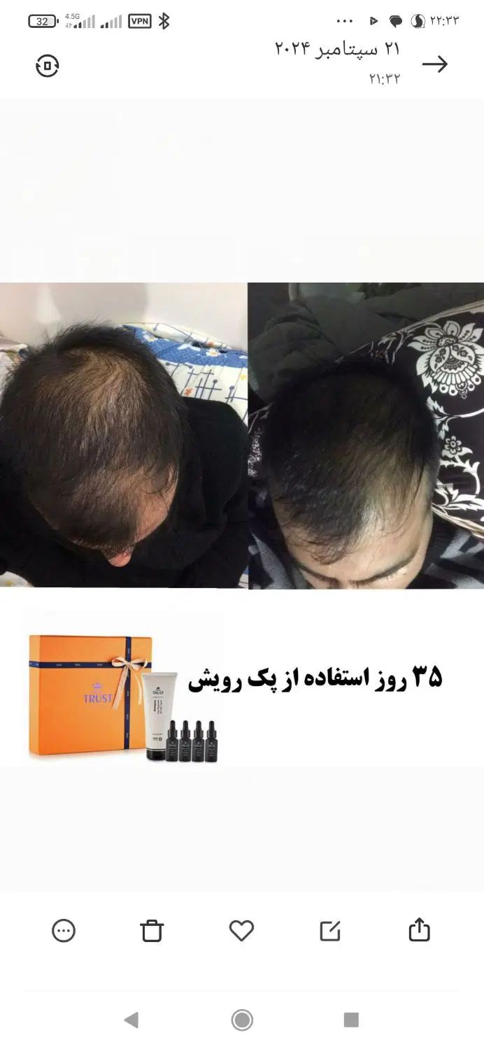 درمان قطعی و تضمینی ریزش شدید مو ( مقطعی و سکه ای)|آرایشی، بهداشتی، درمانی|رشت, حاجی آباد|دیوار