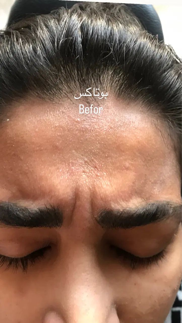 پاکسازی و فیشیال پوست  ازبین بردن لک مخصوص بانوان|خدمات آرایشگری و زیبایی|آمل, |دیوار