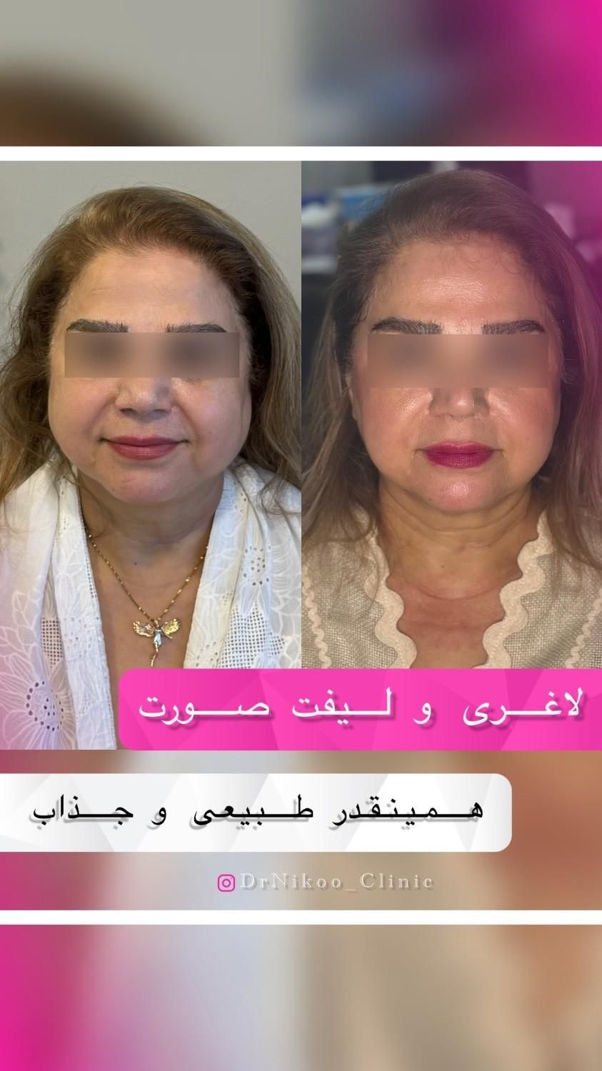 تخفیف طلایی بوتاکس و مزوتراپی|خدمات آرایشگری و زیبایی|تهران, جماران (نیاوران)|دیوار