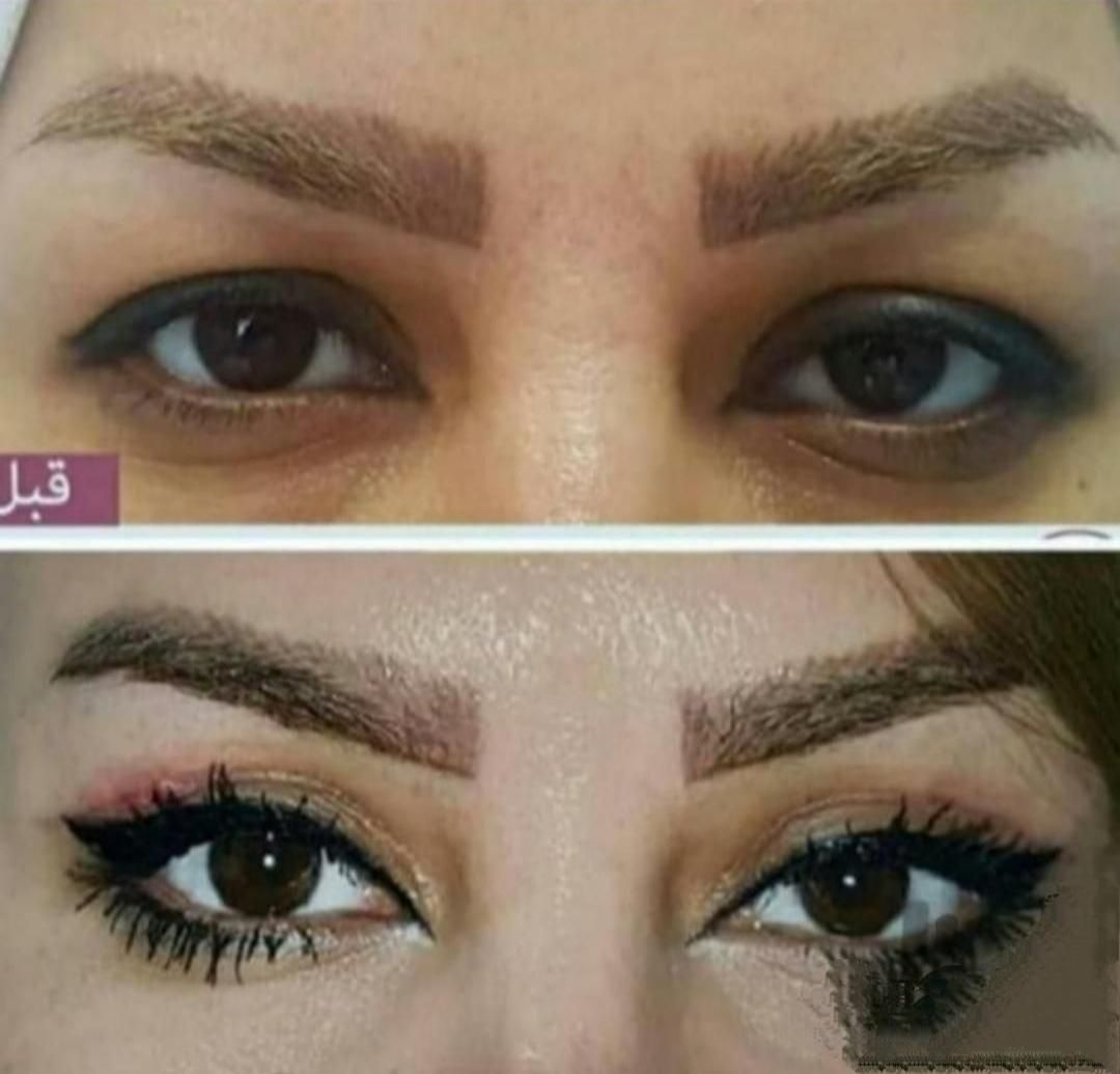 بوتاکس وتزریق ژل لیفت نخ بلفاروساکشن وکاشت مو|خدمات آرایشگری و زیبایی|مشهد, آزادشهر|دیوار