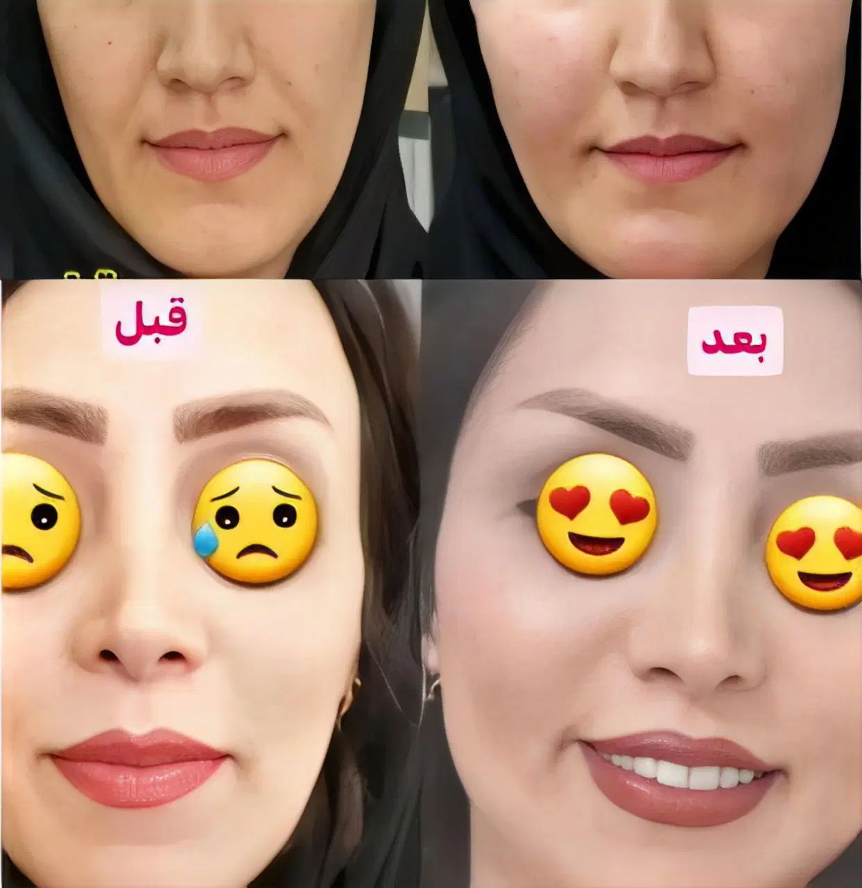 پرکننده طبیعی صورت|خوردنی و آشامیدنی|کرج, پیشاهنگی|دیوار