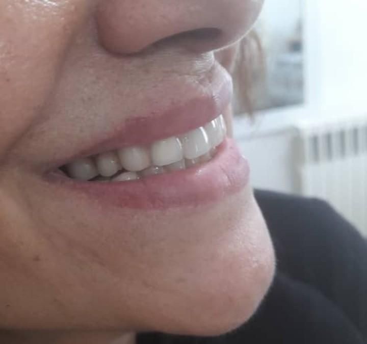 ساخت دندان مصنوعی فلیپر (تک واحدی و دو واحدی)|خدمات آرایشگری و زیبایی|آمل, |دیوار