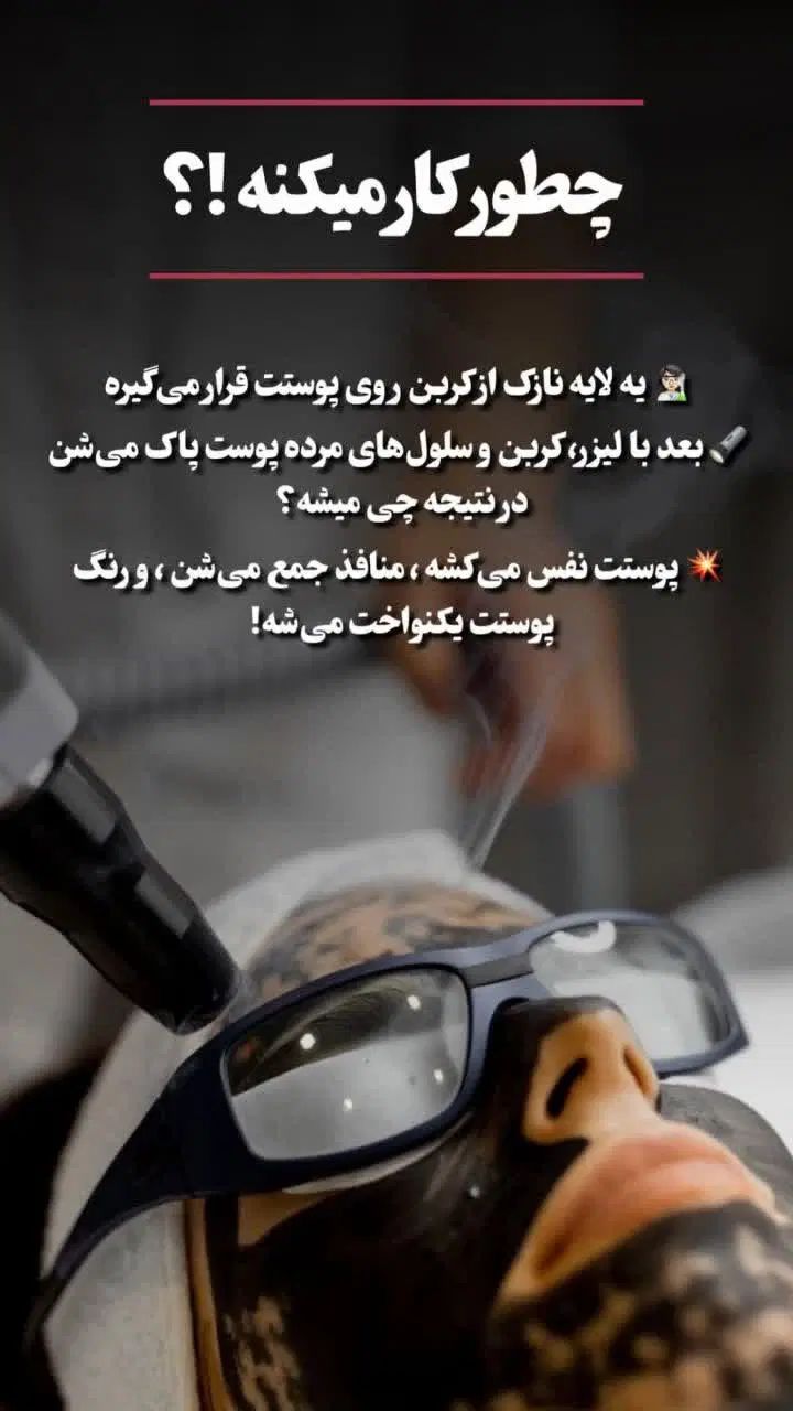 پیلینگ کربن، روشن سازی صورت ،بیکینی  و زانو|خدمات آرایشگری و زیبایی|اسلام‌شهر, زرافشان|دیوار