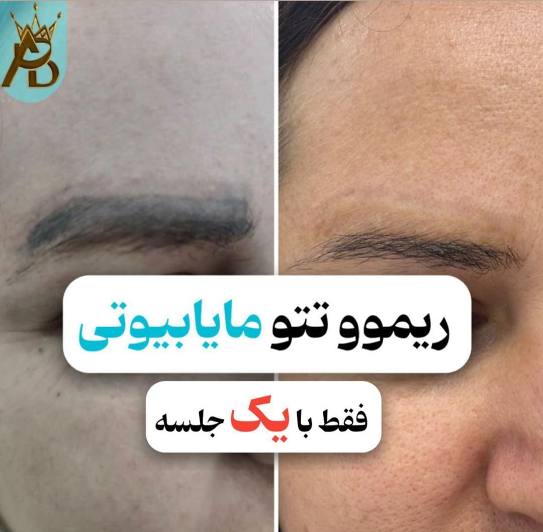 پاک کردن تتو خالکوبی،ریموو تتو ابروـ بدن مایابیوتی|خدمات آرایشگری و زیبایی|یاسوج, |دیوار