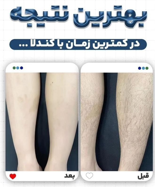 استخدام و آموزش لیزر کندلا لیزر رولی فشیال طب سنتی|استخدام درمانی، زیبایی، بهداشتی|اصفهان, سعادت‌آباد|دیوار