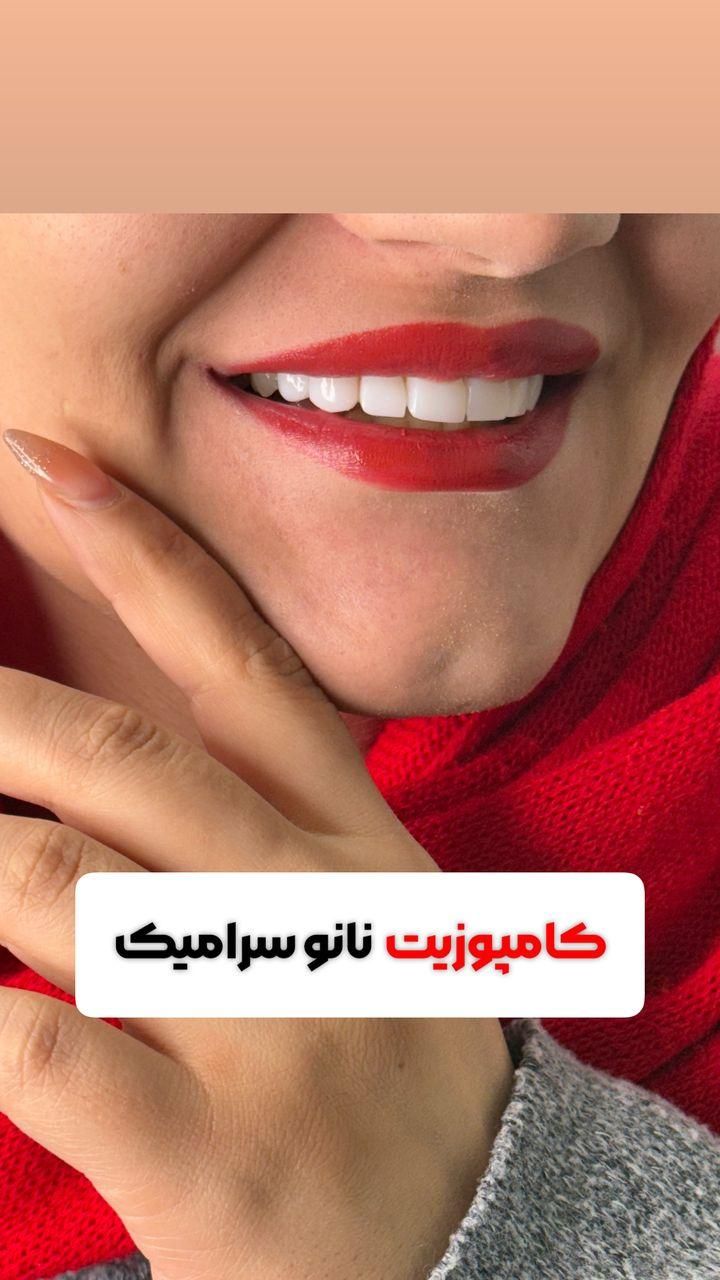 دندانپزشکی ((اقساط)) کامپوزیتـ ایمپلنت عصب کشی|خدمات آرایشگری و زیبایی|قدس, شهر‌قدس|دیوار