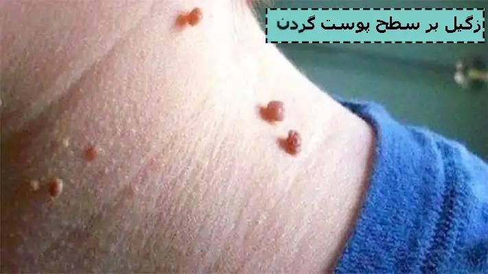 برداشتن انواع خال زگیل نشانه با مواد گیاهی تضمینی|خدمات آرایشگری و زیبایی|کرمانشاه, |دیوار