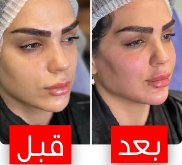 جشنواره  تزریق چربی لیزر لاغری ژل بوتاکس|خدمات آرایشگری و زیبایی|تهران, هفت حوض|دیوار