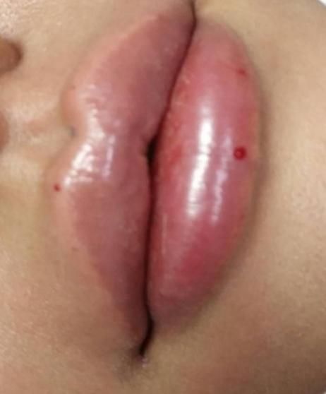 تزریق ژل و بوتاکس|خدمات آرایشگری و زیبایی|بندر کنگان, |دیوار