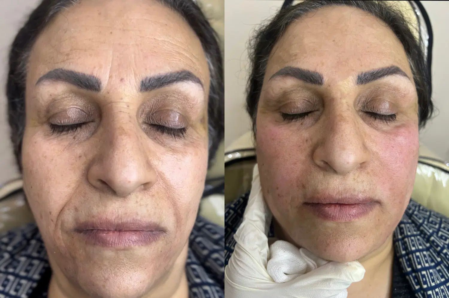 تزریق فیلر و بوتاکس اقساط توسط پزشک در مطب|خدمات آرایشگری و زیبایی|خرمشهر, |دیوار