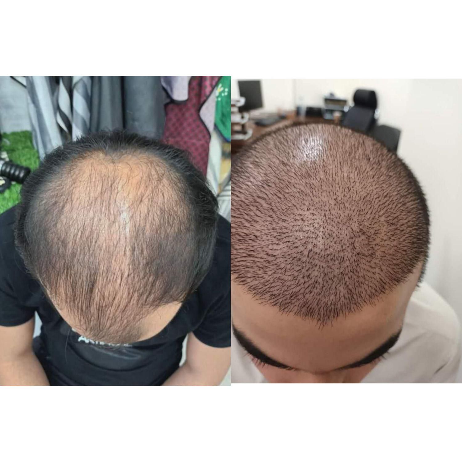 کاشت مو طبیعی شیراز|خدمات آرایشگری و زیبایی|شیراز, قصرالدشت|دیوار