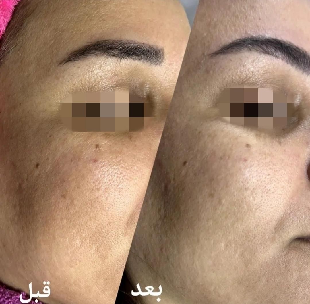 فشیال وپاکسازی صورت|خدمات آرایشگری و زیبایی|نیشابور, شهرک اندیشه|دیوار