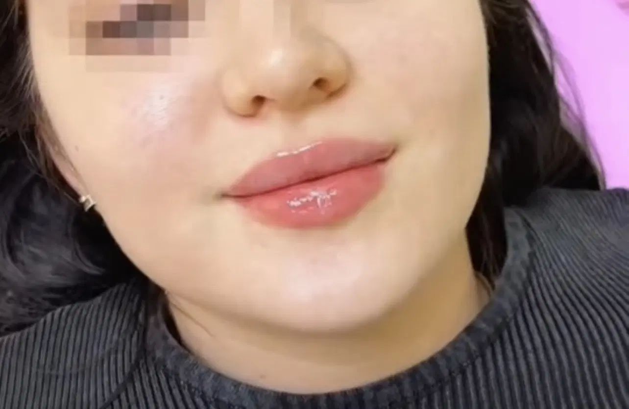 تزریق تخصصی فیلر صورت و لب رایگان جهت مدل|خدمات آرایشگری و زیبایی|تهران, ونک|دیوار