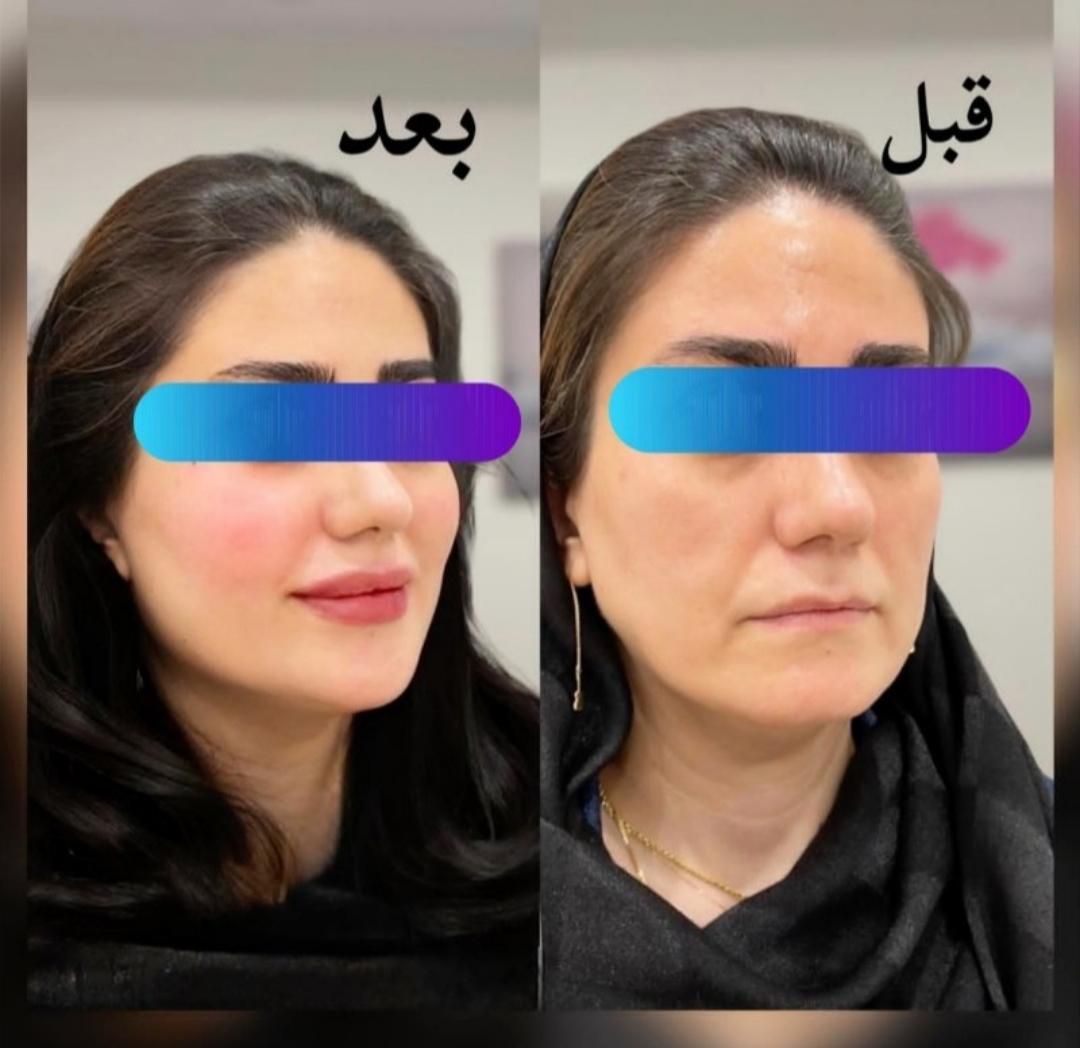 آف ویژه تزریق ژل و بوتاکس|خدمات آرایشگری و زیبایی|یاسوج, |دیوار