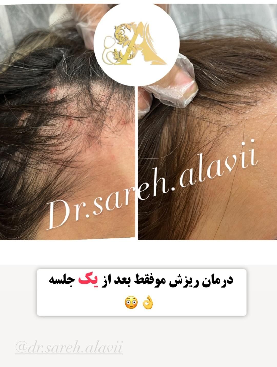 درمان ریزش مو توسط پزشک|خدمات آرایشگری و زیبایی|قم, دورشهر|دیوار