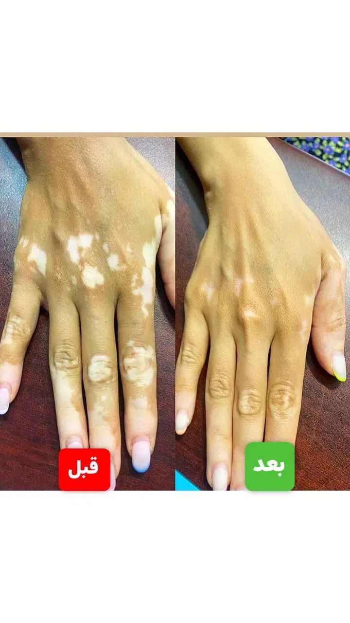 درمان دائمی بیماری پیسی وپسوریازیس واگزما|خدمات آرایشگری و زیبایی|امیدیه, |دیوار