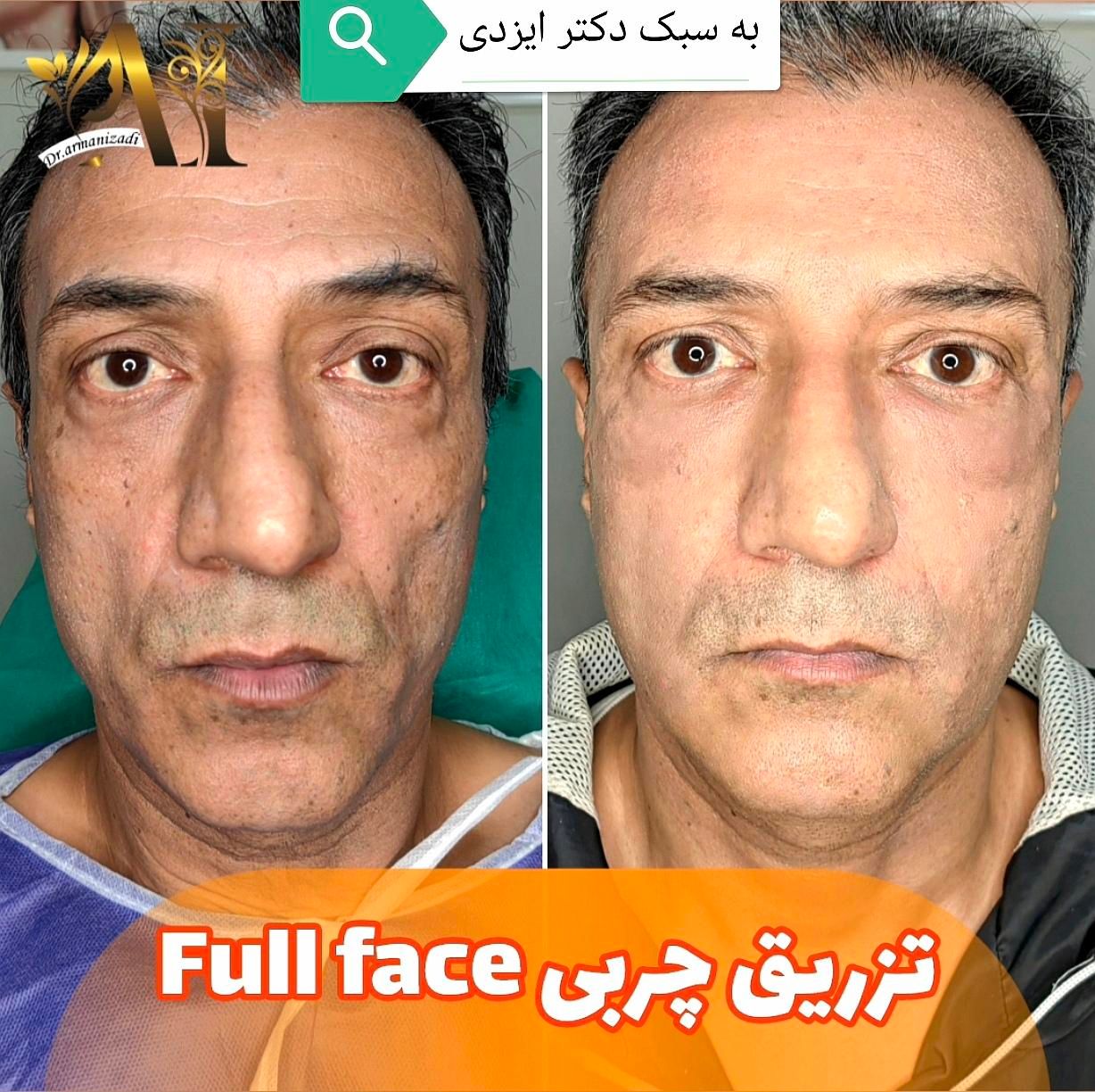چربی بیکینی لابیا پلاستی تنگی انواع جراحی لیفت|خدمات آرایشگری و زیبایی|شیراز, شهرک گلستان|دیوار