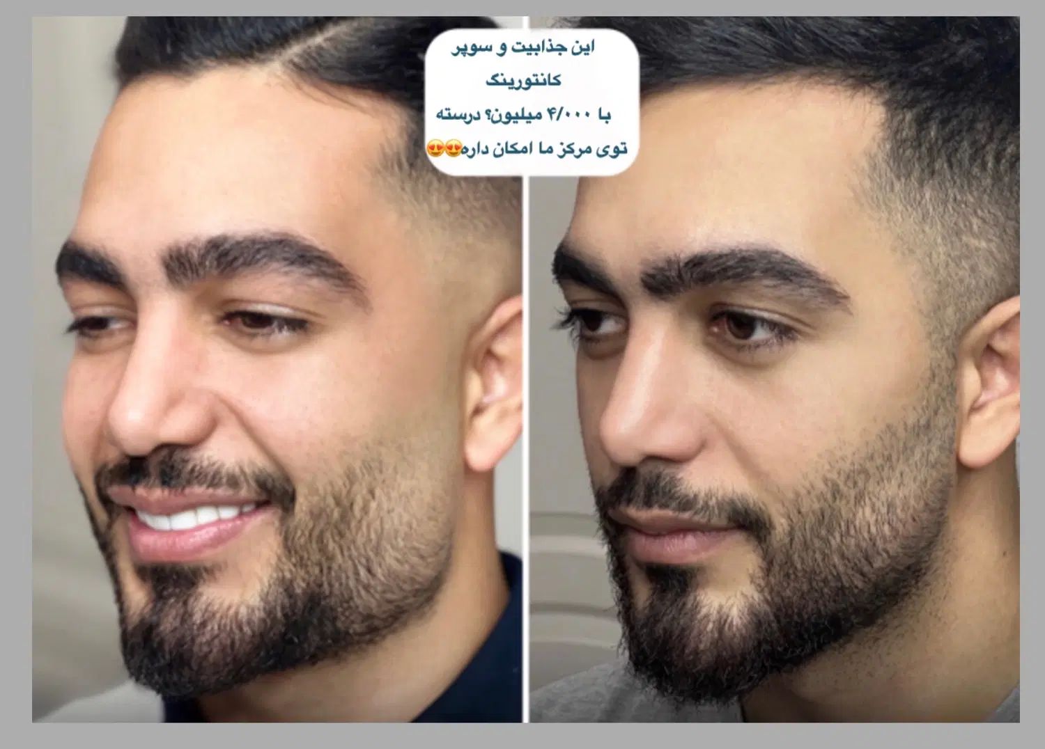 تزریق ژل لب بوتاکس کانتورینگ صورت جوانسازی لیفت|خدمات آرایشگری و زیبایی|تهران, صادقیه|دیوار