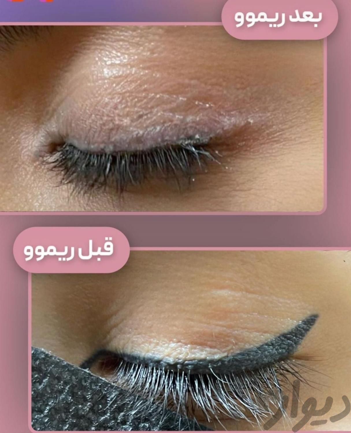 از شر تتو های قدیمی خلاص شو|خدمات آرایشگری و زیبایی|قم, سالاریه|دیوار