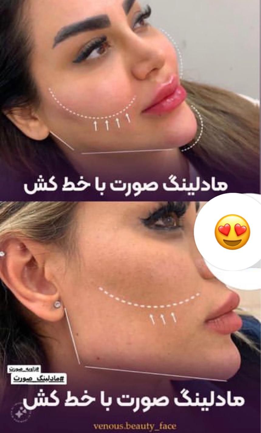 کلینیک مادلینگ 3900تزریق ژللب بیکینی390بوتاکس لیزر|خدمات آرایشگری و زیبایی|تهران, ستارخان|دیوار