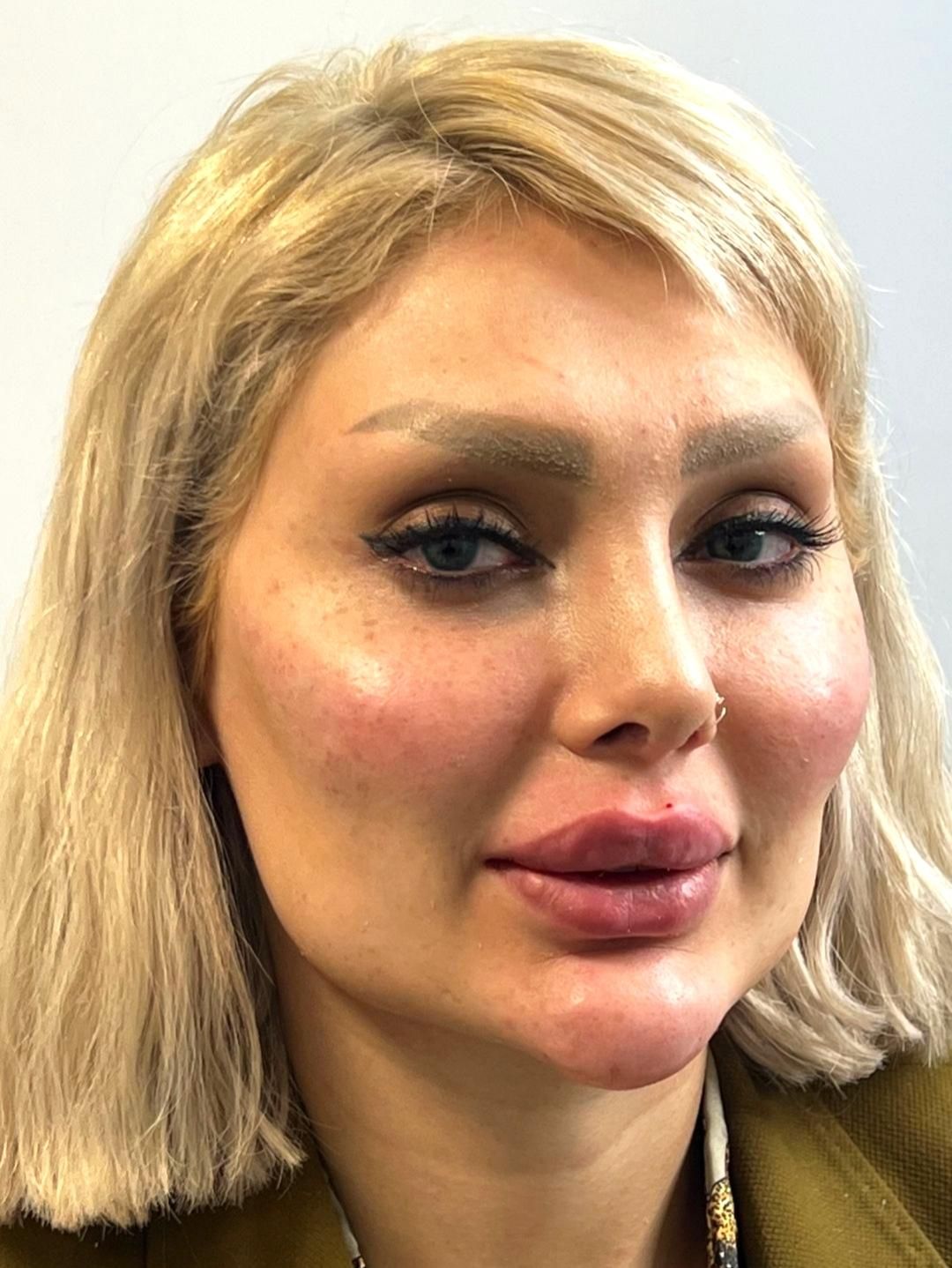 تزریق فیلر صورت مطابق المانهای زیبایی شناسی|خدمات آرایشگری و زیبایی|قرچک, پویینک|دیوار