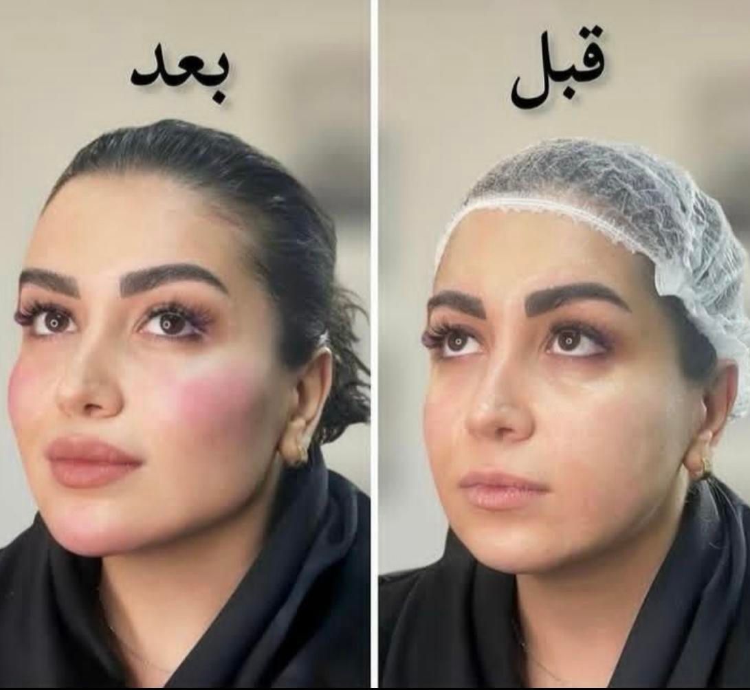 کلینیک تزریق ژل جالپرو لیزر بوتاکس۴۹۰ زاویه پزشک|خدمات آرایشگری و زیبایی|تهران, صادقیه|دیوار