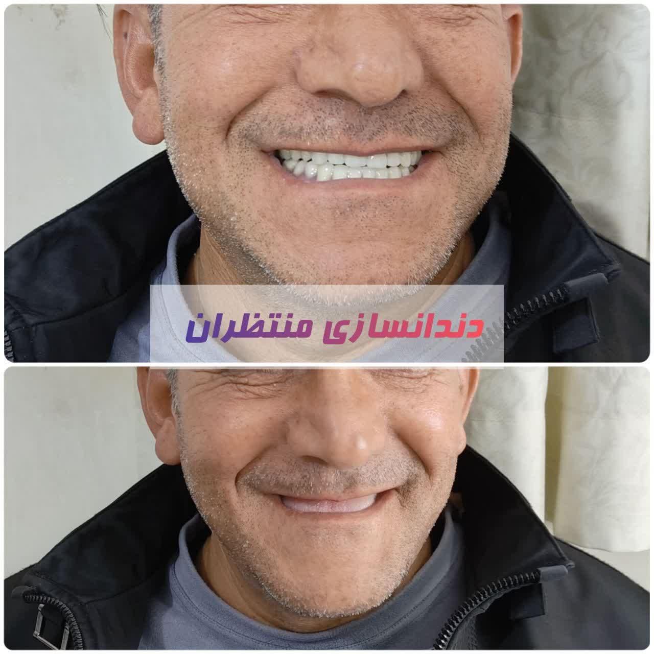 دندان مصنوعی/ ضمانتی / ایتالیایی/ جوان پسند|خدمات آرایشگری و زیبایی|مشهد, امام رضا (ع)|دیوار