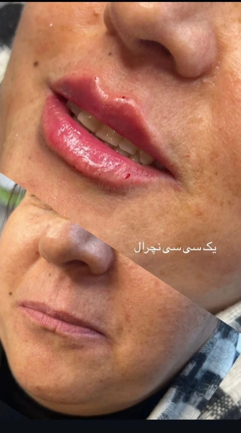تخفیف انواع فیلر و بوتاکس توسط پزشک|خدمات آرایشگری و زیبایی|اصفهان, خلجا|دیوار
