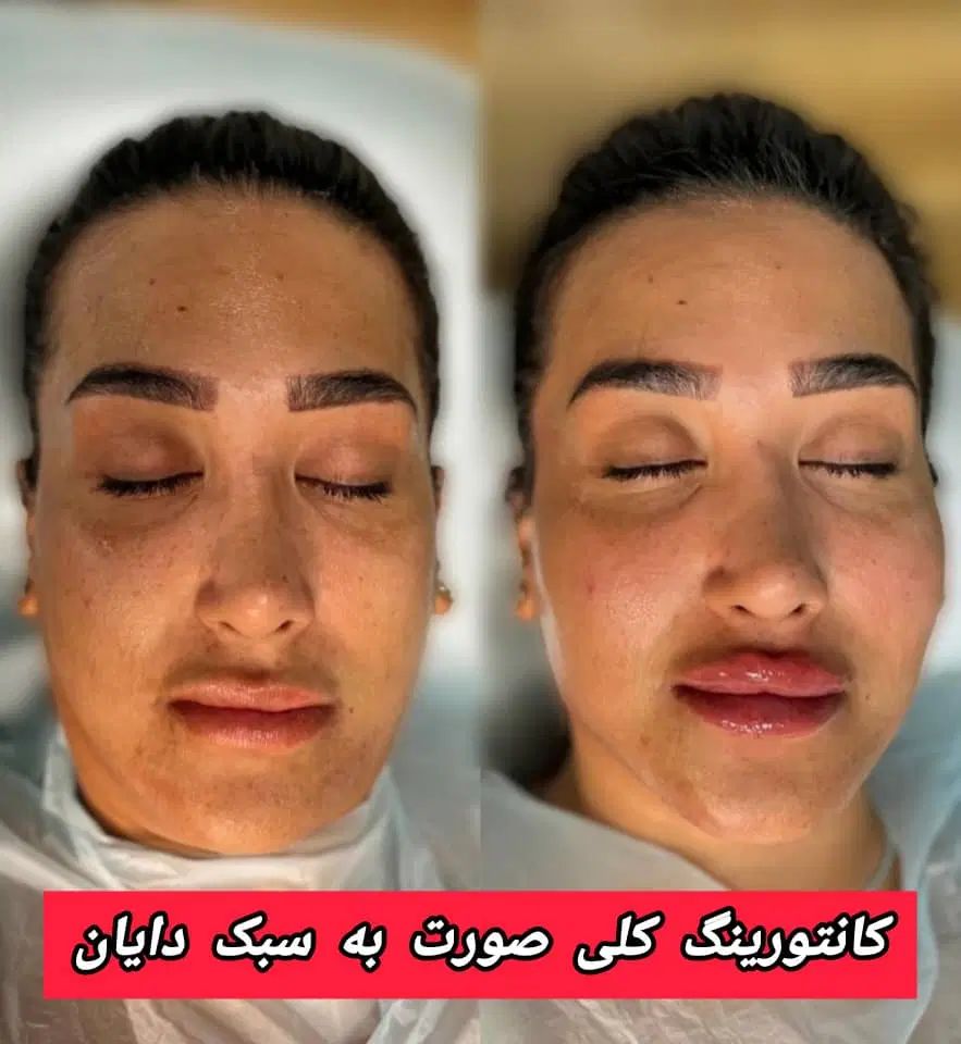 جشنواره تخفیف ویژه فیلربوتاکس انزیم وقت فوری|خدمات آرایشگری و زیبایی|کرج, گوهردشت|دیوار