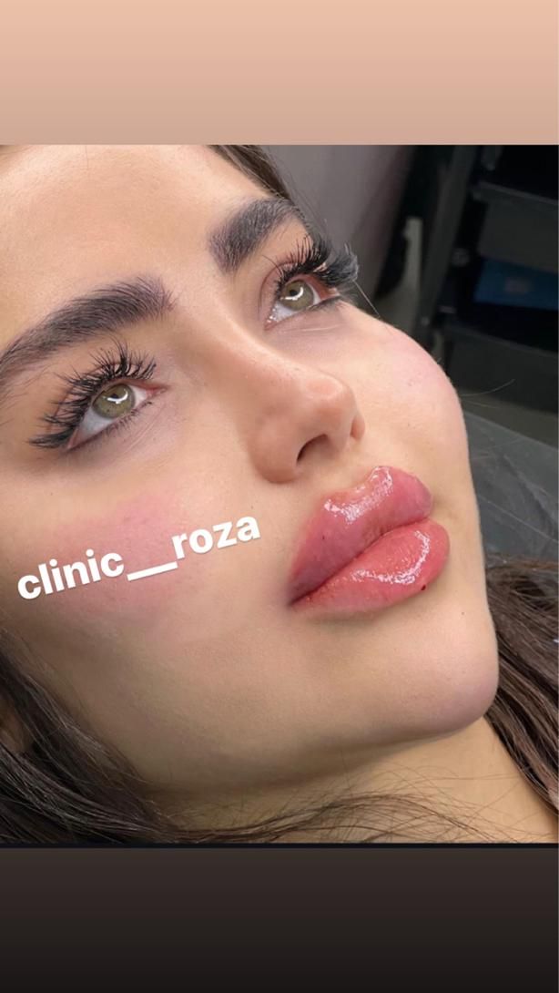 مدل تزریق ژل فیلر کانتورینگ عربی لب روسی|خدمات آرایشگری و زیبایی|کرج, گوهردشت|دیوار