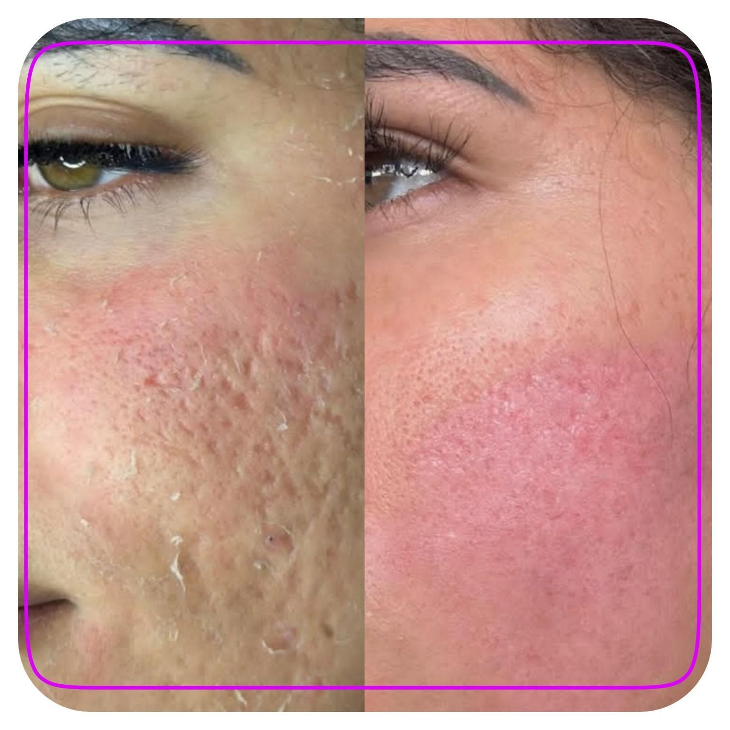 پاکسازی پوست درمان جوش جای جوش لک و کک ومک|خدمات آرایشگری و زیبایی|اصفهان, ملک‌شهر|دیوار