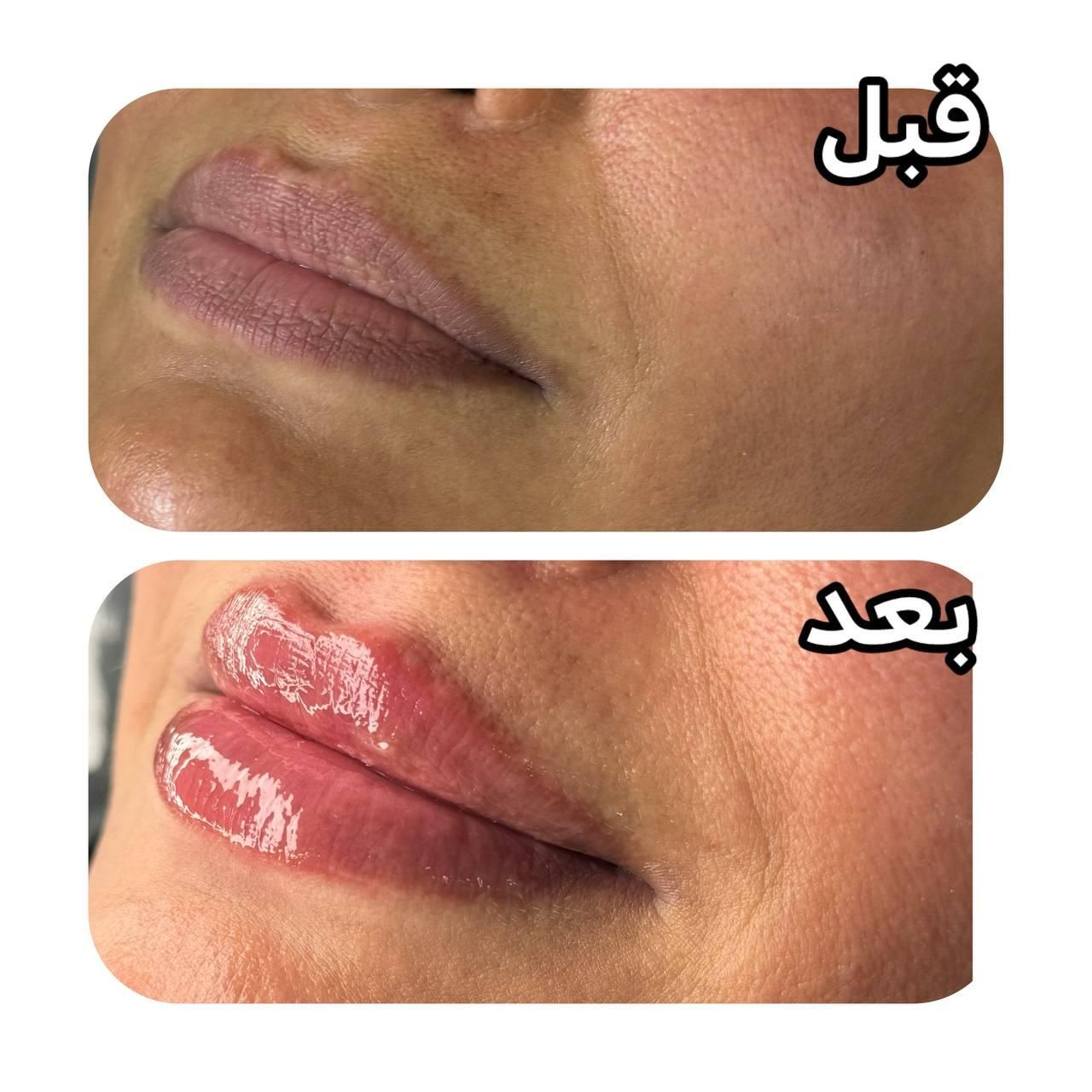 لیزر شاتی الکساندرایت نابلکس بوتاکس فیلر ژل نخ و .|خدمات آرایشگری و زیبایی|تهران, مشیریه|دیوار
