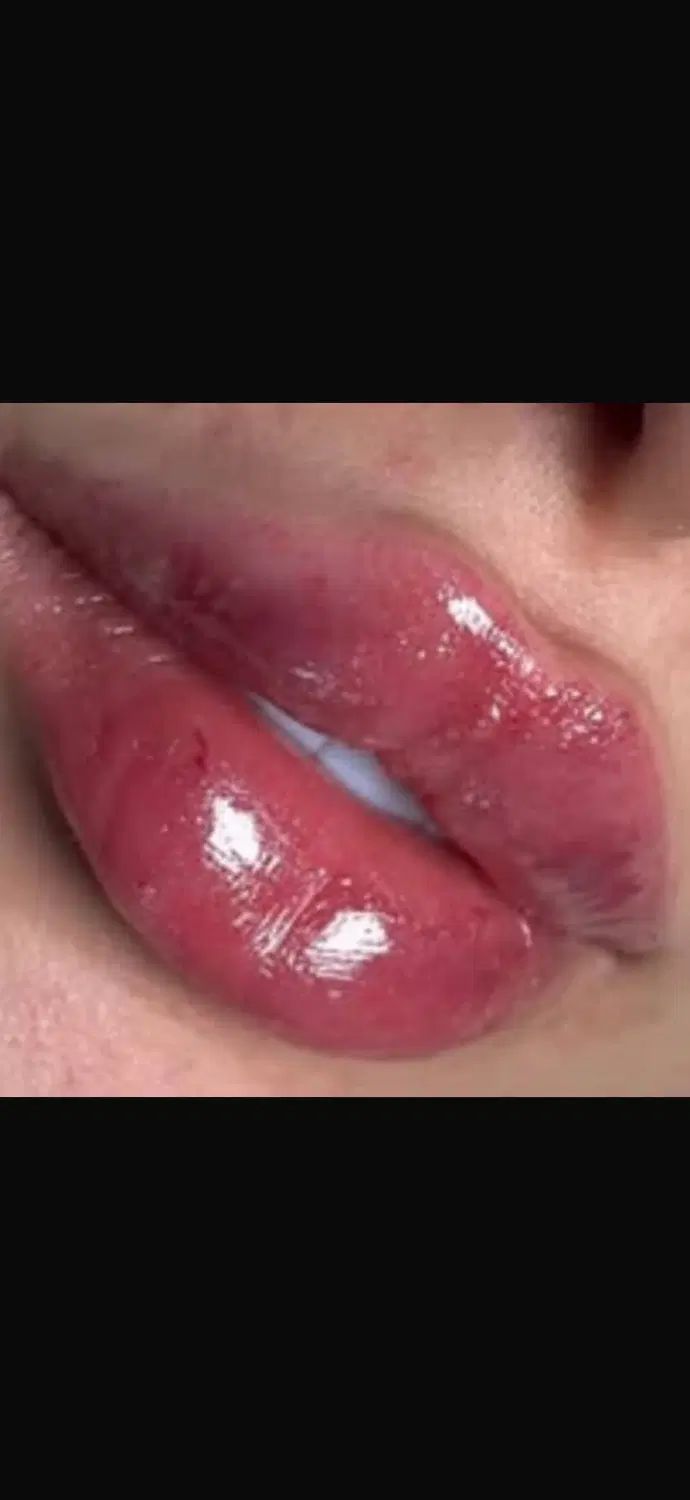 فیلر ژل لب تخصصی بوتاکس پزشک کلینیک زیبایی|خدمات آرایشگری و زیبایی|تهران, تهرانسر مرکزی|دیوار