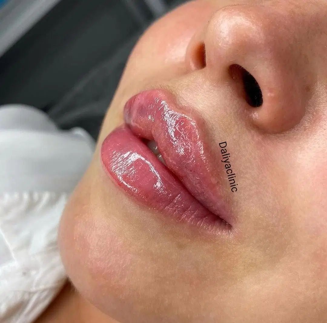 تزریق ژل (فیلر)و بوتاکس و لیفت بانخ ومادلینگ صورت|خدمات آرایشگری و زیبایی|تهران, هفت حوض|دیوار