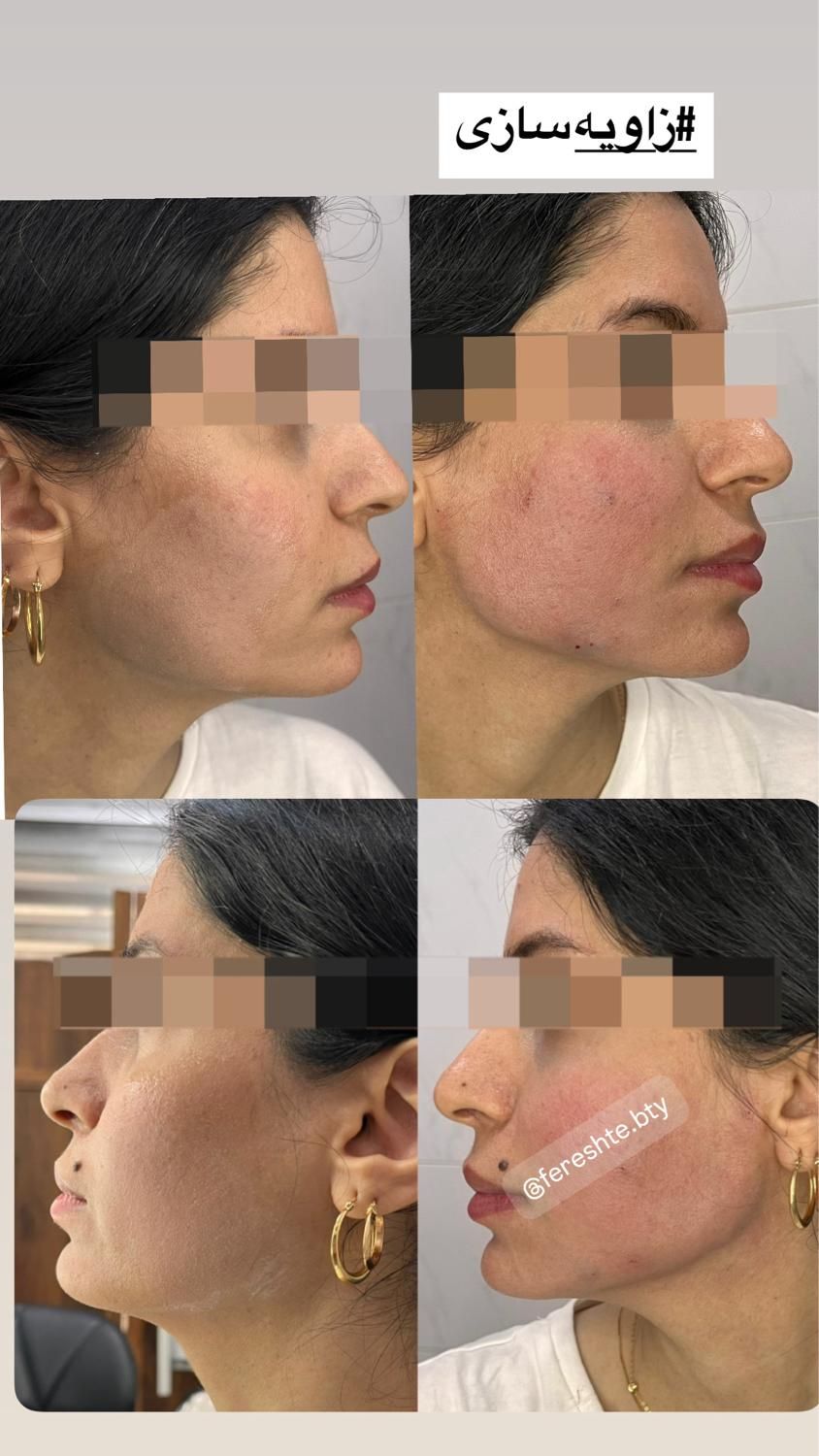 لیزر، ژل،بوتاکس،خال برداری و الکترولیز،لیبیاپلاستی|خدمات آرایشگری و زیبایی|شیراز, پانصد دستگاه ارتش|دیوار