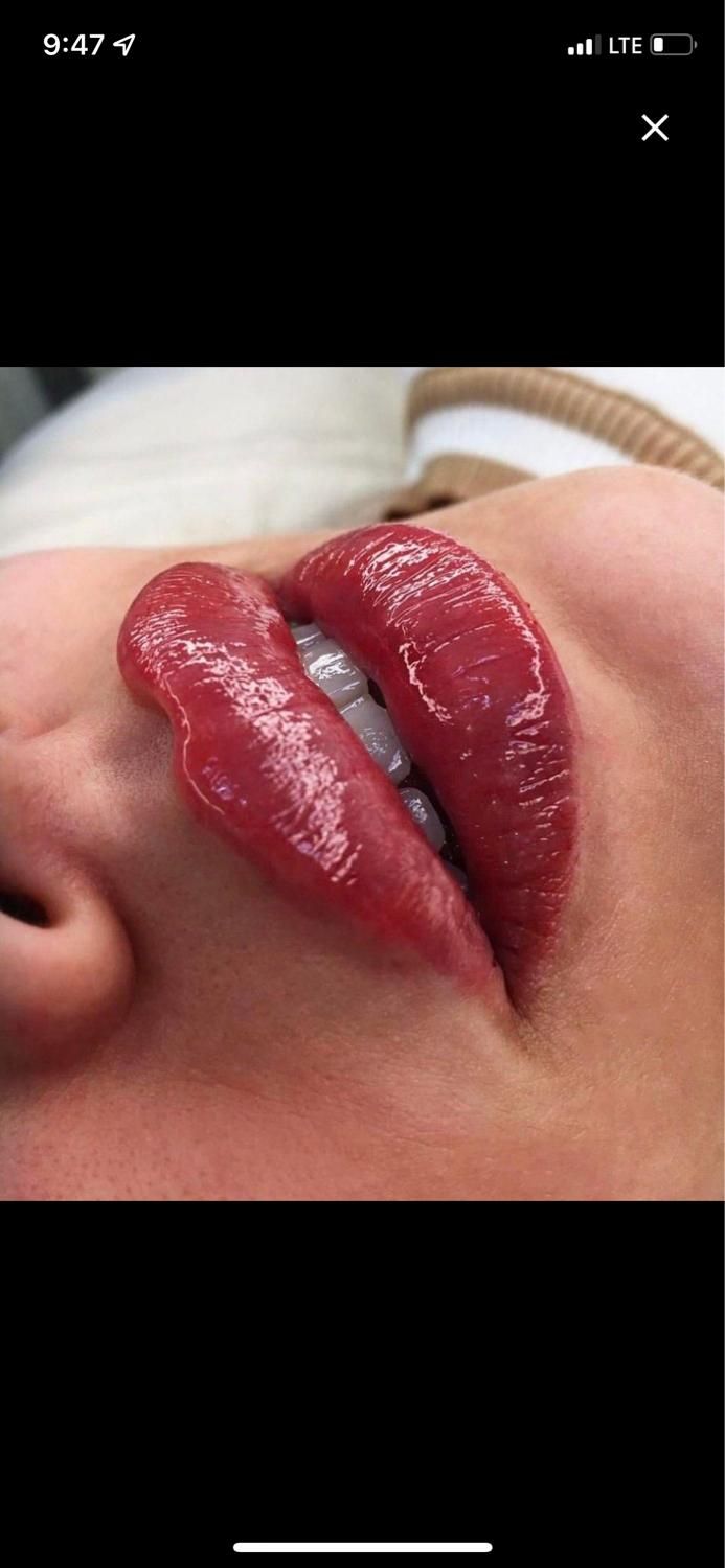 کلینیک تزریق ژل بوتاکس390 توسط پزشک لیزرشاتی هایفو|خدمات آرایشگری و زیبایی|تهران, ستارخان|دیوار