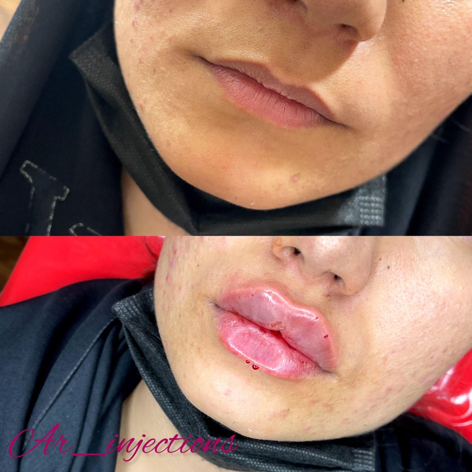 آموزش و تزریق ژل و بوتاکس|خدمات آرایشگری و زیبایی|مسجد سلیمان, |دیوار