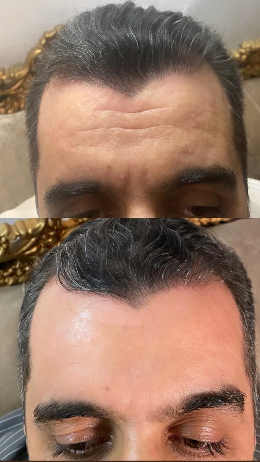 تزریق بوتاکس کل صورت و زیر بغل|خدمات آرایشگری و زیبایی|کرمانشاه, |دیوار