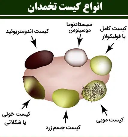 پاکسازی و بهبود رحم ،کیست،فیبروم و تنبلی تخمدان|آرایشی، بهداشتی، درمانی|گنبد کاووس, |دیوار