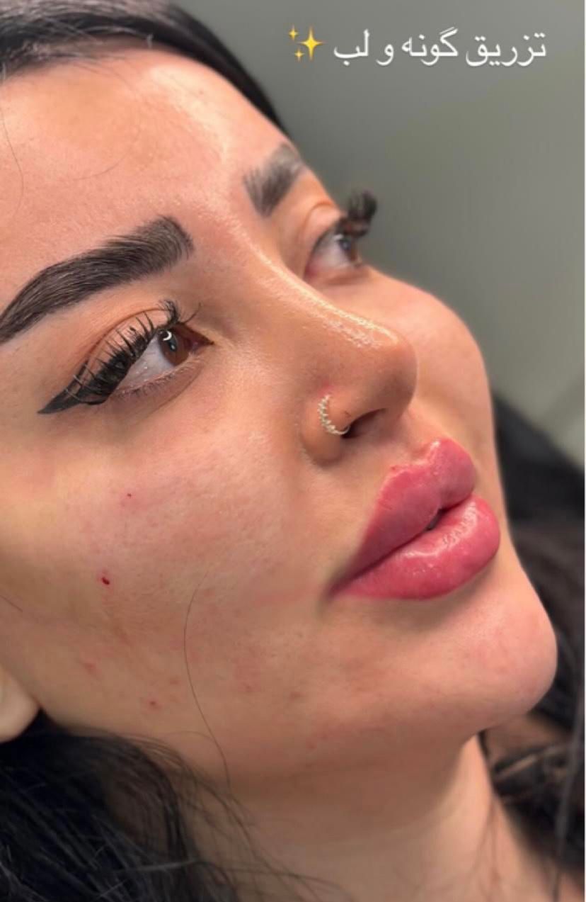 مدل بوتاکس و پی ار پی و کانتورینگ صورت با فیلر|خدمات آرایشگری و زیبایی|اصفهان, ملک‌شهر|دیوار