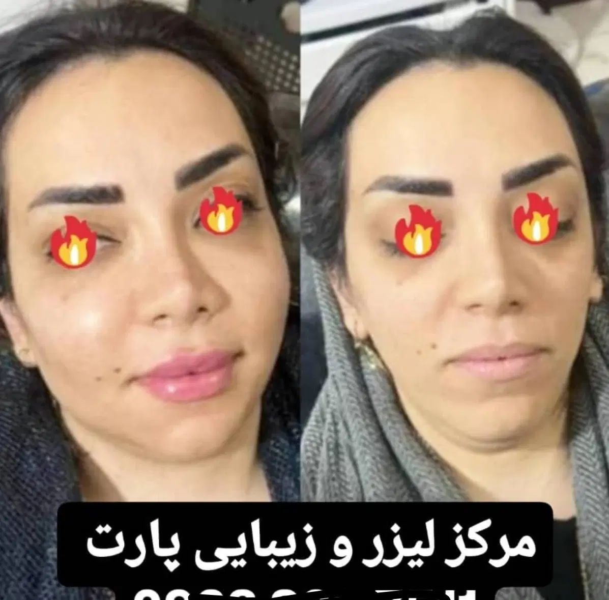 خدمات ژل بوتاکس چربی با زیباترین نتایج وقیمت مناسب|خدمات آرایشگری و زیبایی|دوگنبدان, |دیوار