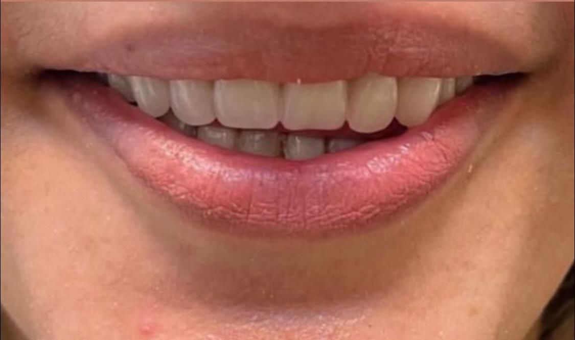 دندان مصنوعی (پروتز)|خدمات آرایشگری و زیبایی|گالیکش, |دیوار