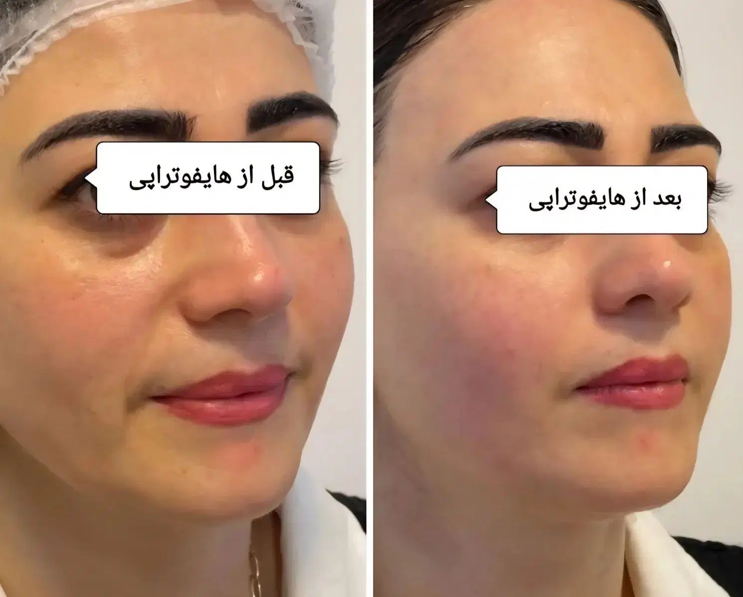 جوانسازی و لیفت پوست بدون جراحی با قویترین هایفو|خدمات آرایشگری و زیبایی|کرج, فاز ۲ مهرشهر|دیوار