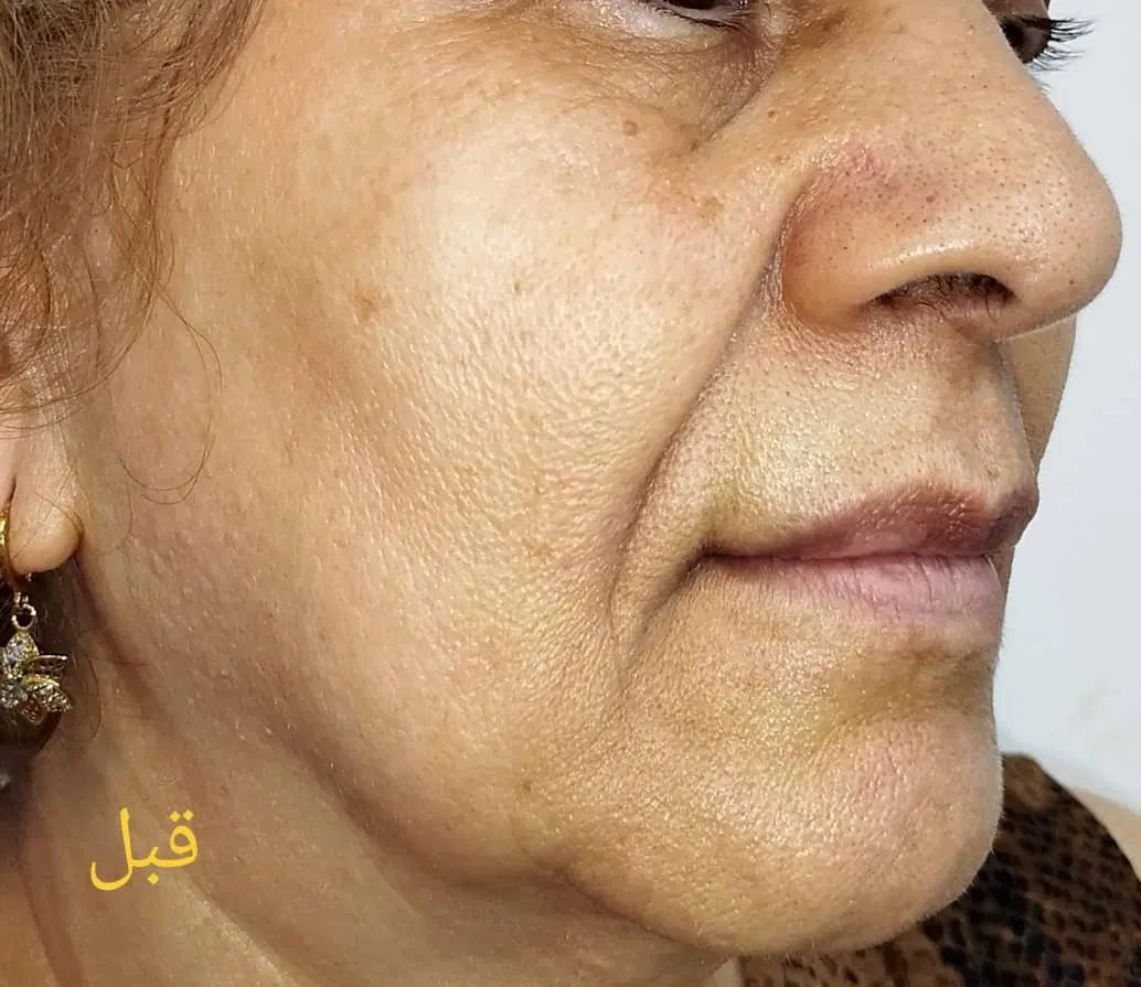 لیفت وجوانسازی قوی صورت|خدمات آرایشگری و زیبایی|رشت, گلسار|دیوار